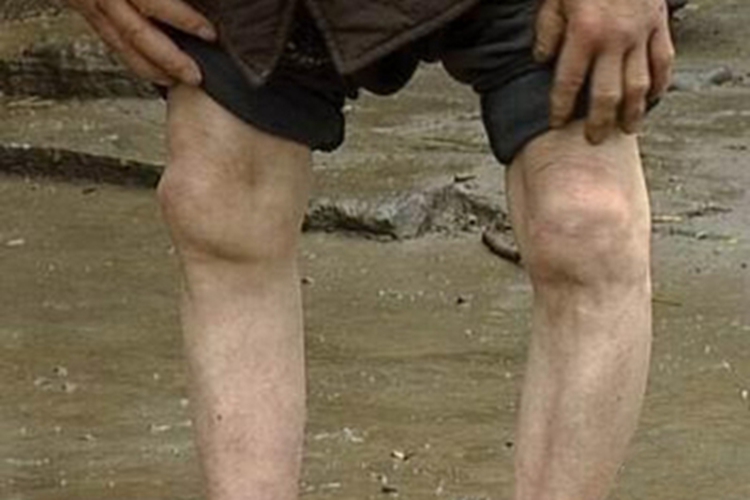 氟骨症腿变形弯曲图 氟骨症腿变形弯曲图