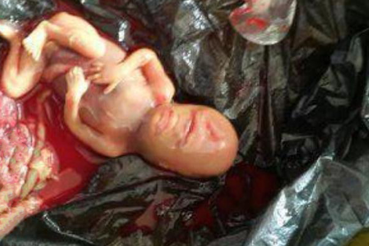 孕11周引产五官能被分辨图