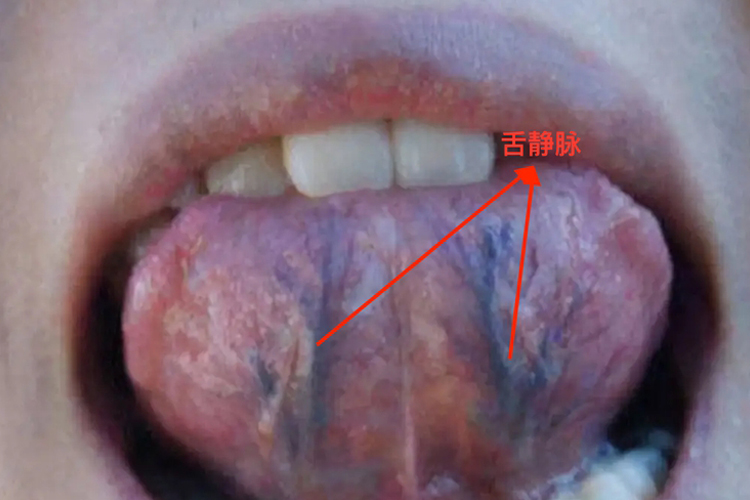 舌头静脉血管图