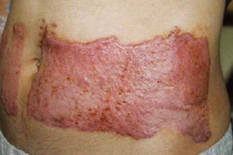 三度烧伤深红色疤痕图