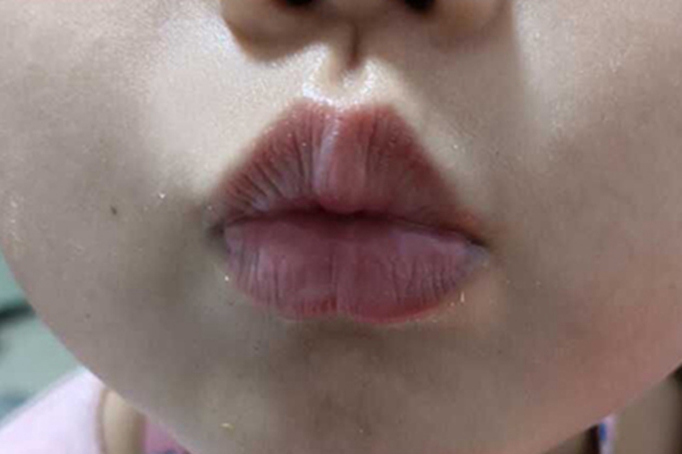 接触性唇炎竖纹图