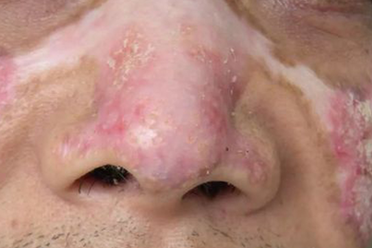 面部盘状红斑狼疮图 面部盘状红斑狼疮图