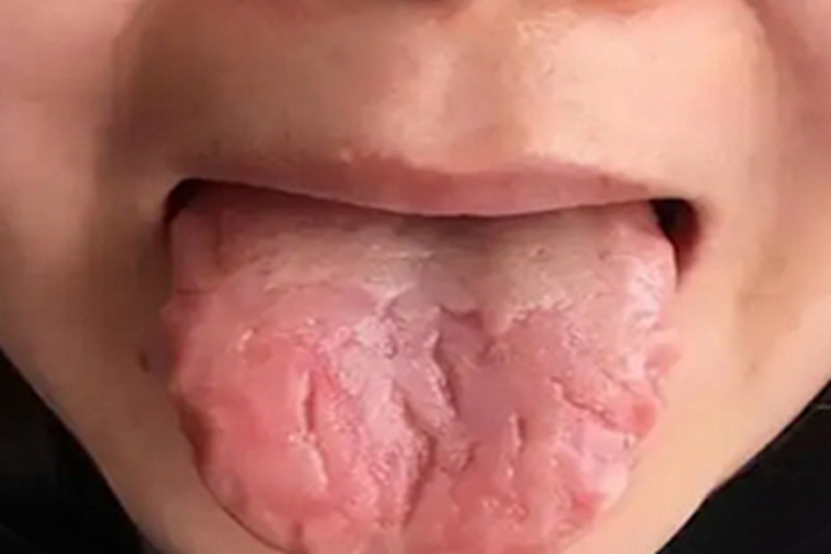 沟纹舌舌头有几条裂纹图 沟纹舌舌头有几条裂纹图