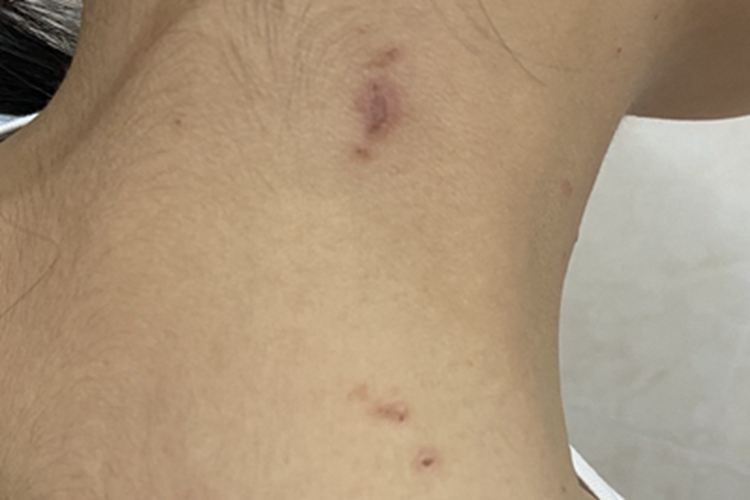 昆虫性皮炎颈部疙瘩图