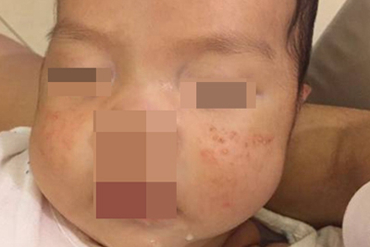 炎症后色素沉着小疙瘩图