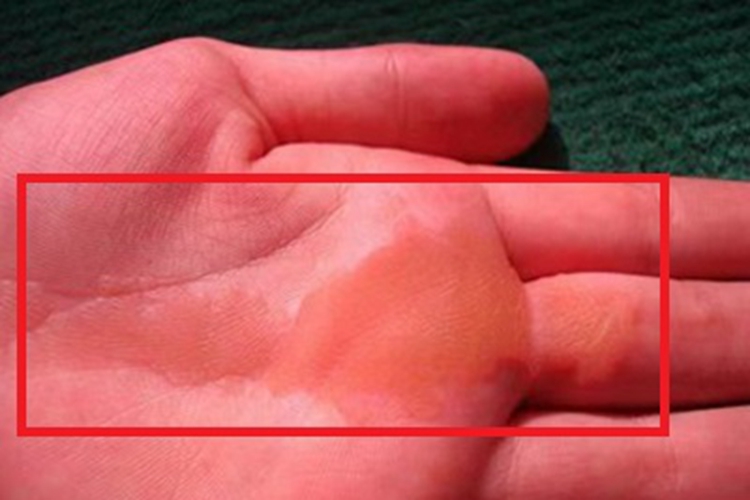 钱币状掌跖角化病硬块图