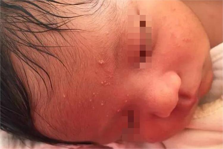 婴儿痤疮挤出白色硬米粒图