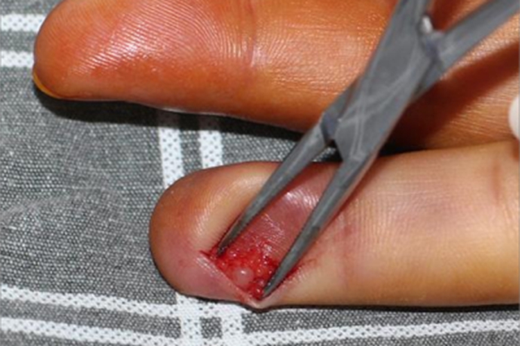 血管球瘤手指症状图 血管球瘤手指症状图