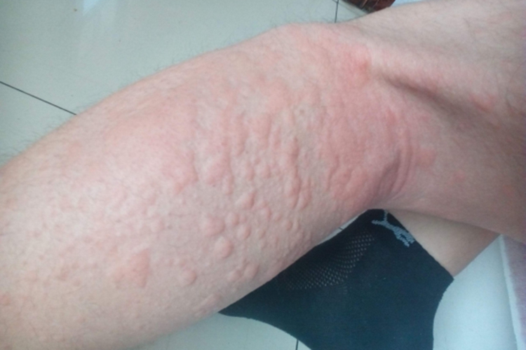 吃辣条身上起荨麻疹图