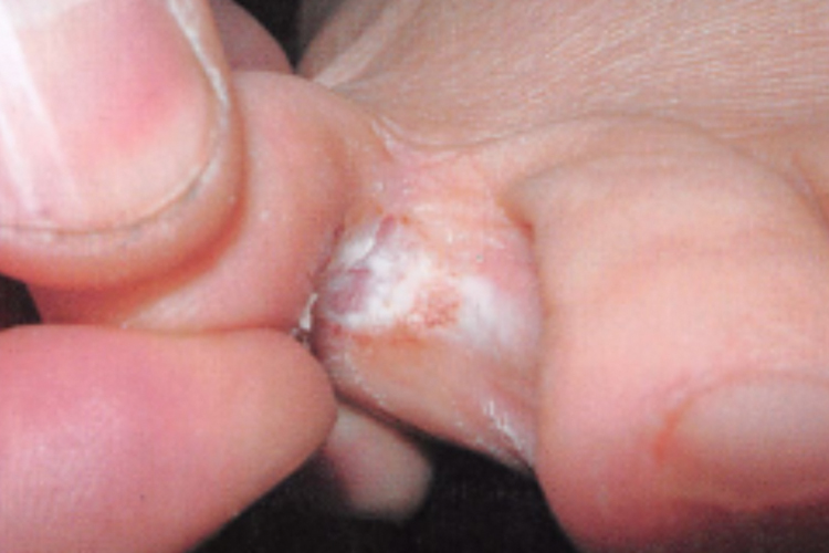 足癣浸渍糜烂型图