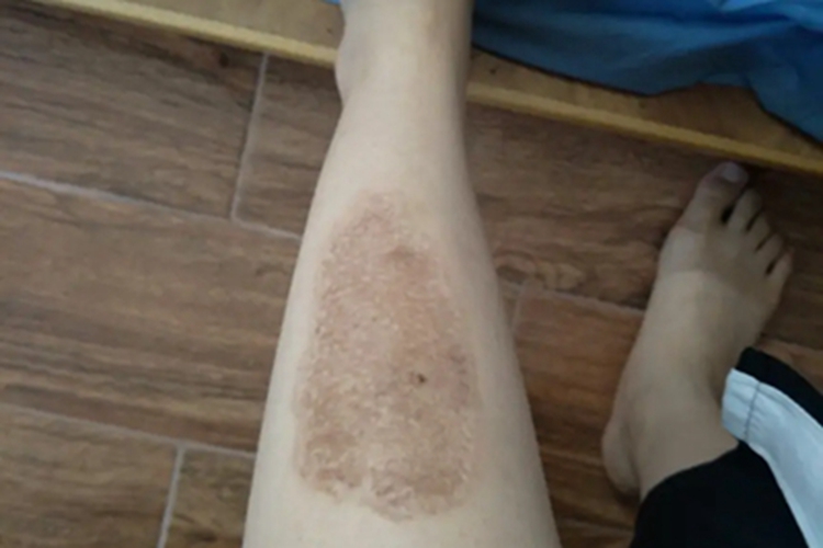 咖啡斑小腿症状图