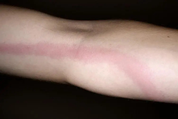 管状淋巴管炎红色条线图