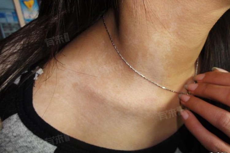 无色素痣白斑怎么治疗