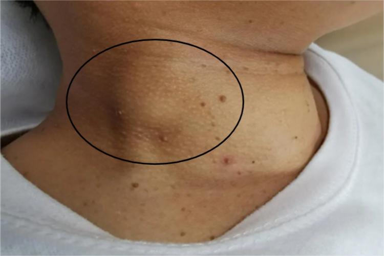 颈部纤维瘤肿块图