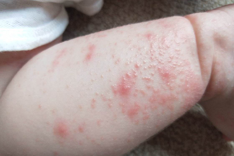 湿疹图 湿疹图