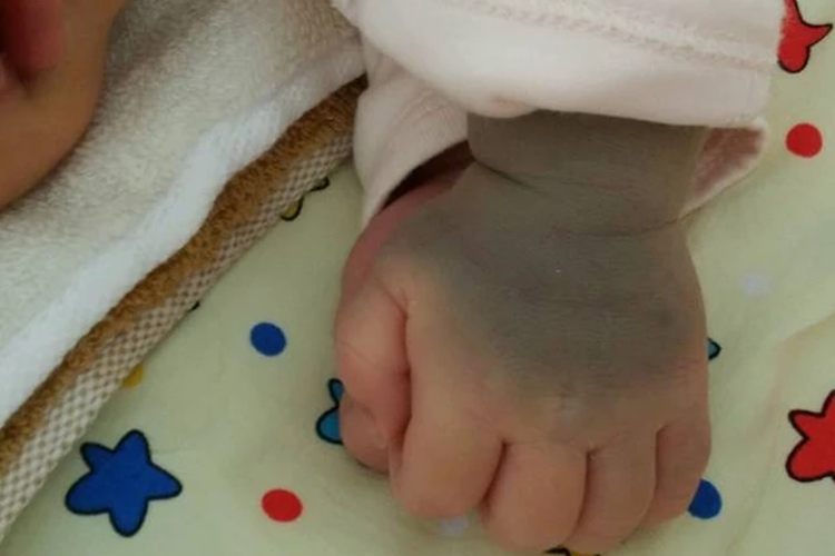 婴儿蒙古斑胎记图