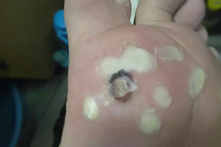 寻常疣冷冻后瘢痕图