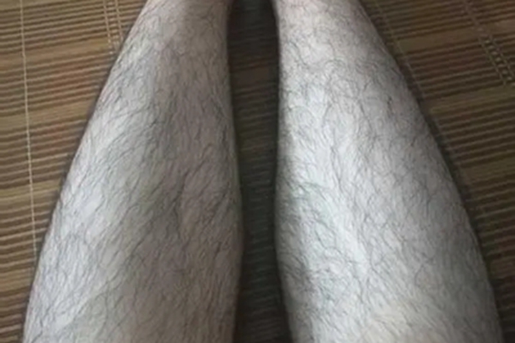 多毛症小腿上汗毛粗长图