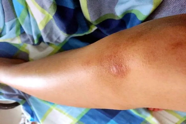 擦伤膝盖瘢痕图 擦伤膝盖瘢痕图