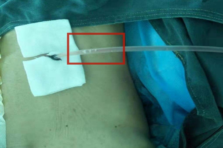 肾造瘘白色絮状图