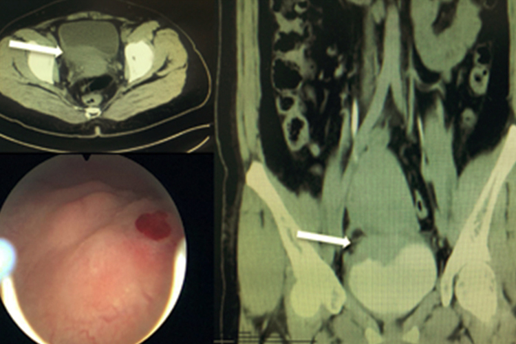 膀胱浸润性癌扁平溃疡图 膀胱浸润性癌扁平溃疡图