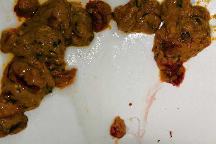 直肠癌脓血便图病因肠癌的病因尚不清楚,可能与遗传