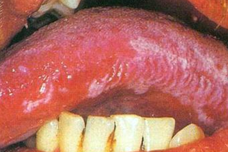 口腔毛状白斑图