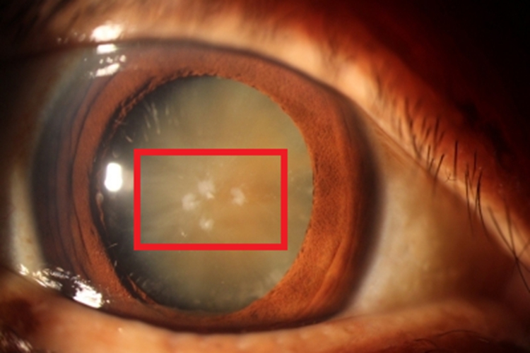 先天性白内障眼球白点图