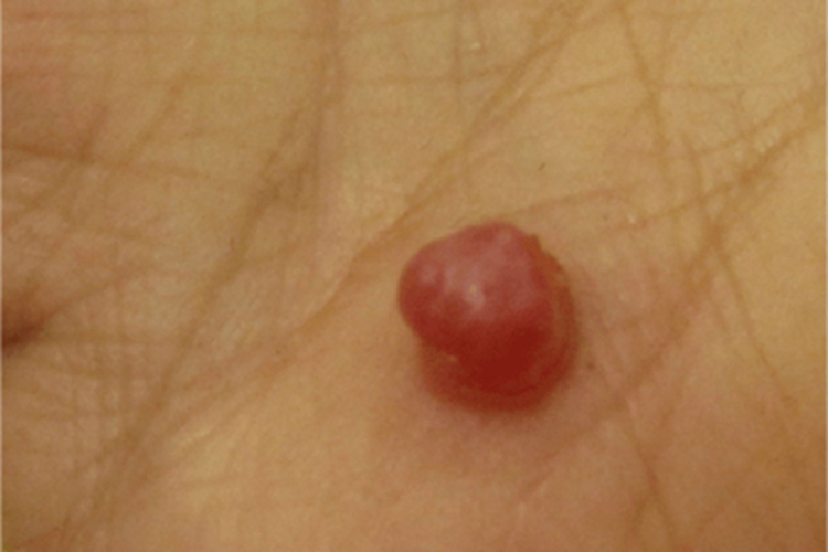 肉芽肿型血管瘤手掌大红疙瘩图 肉芽肿型血管瘤手掌大红疙瘩图