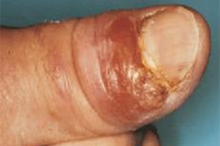 鼻孢子菌病手指肿胀图