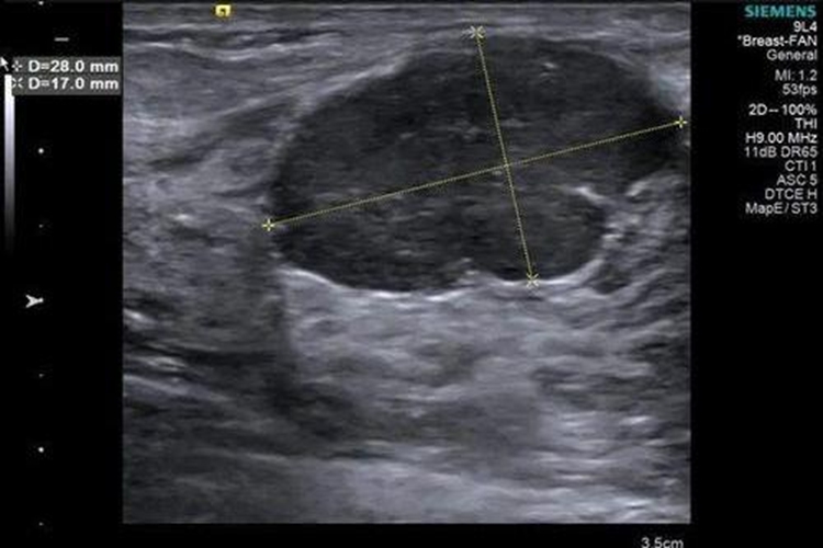 乳腺血管瘤B超图