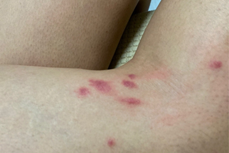 过敏性皮炎大腿结节图