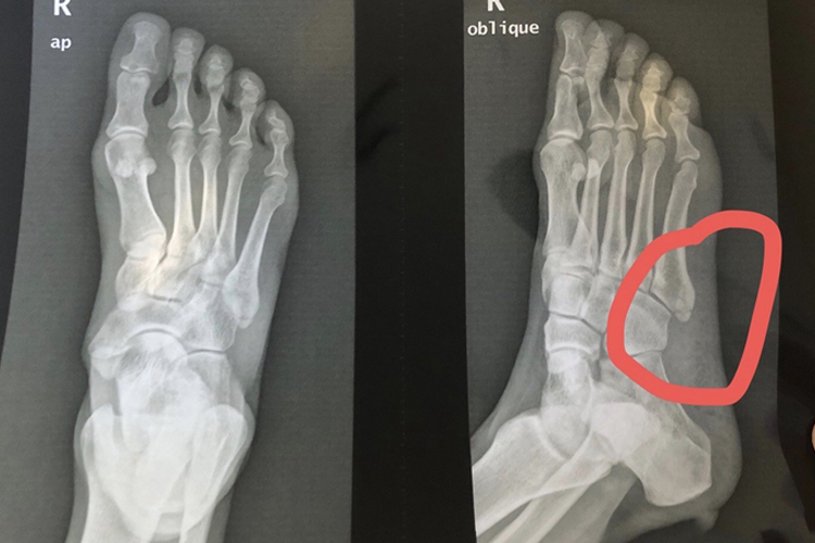 右足第5跖骨基底部骨折图