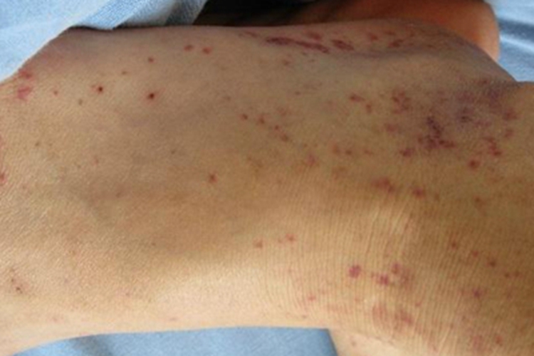 过敏性紫癜脚背有紫色斑点图