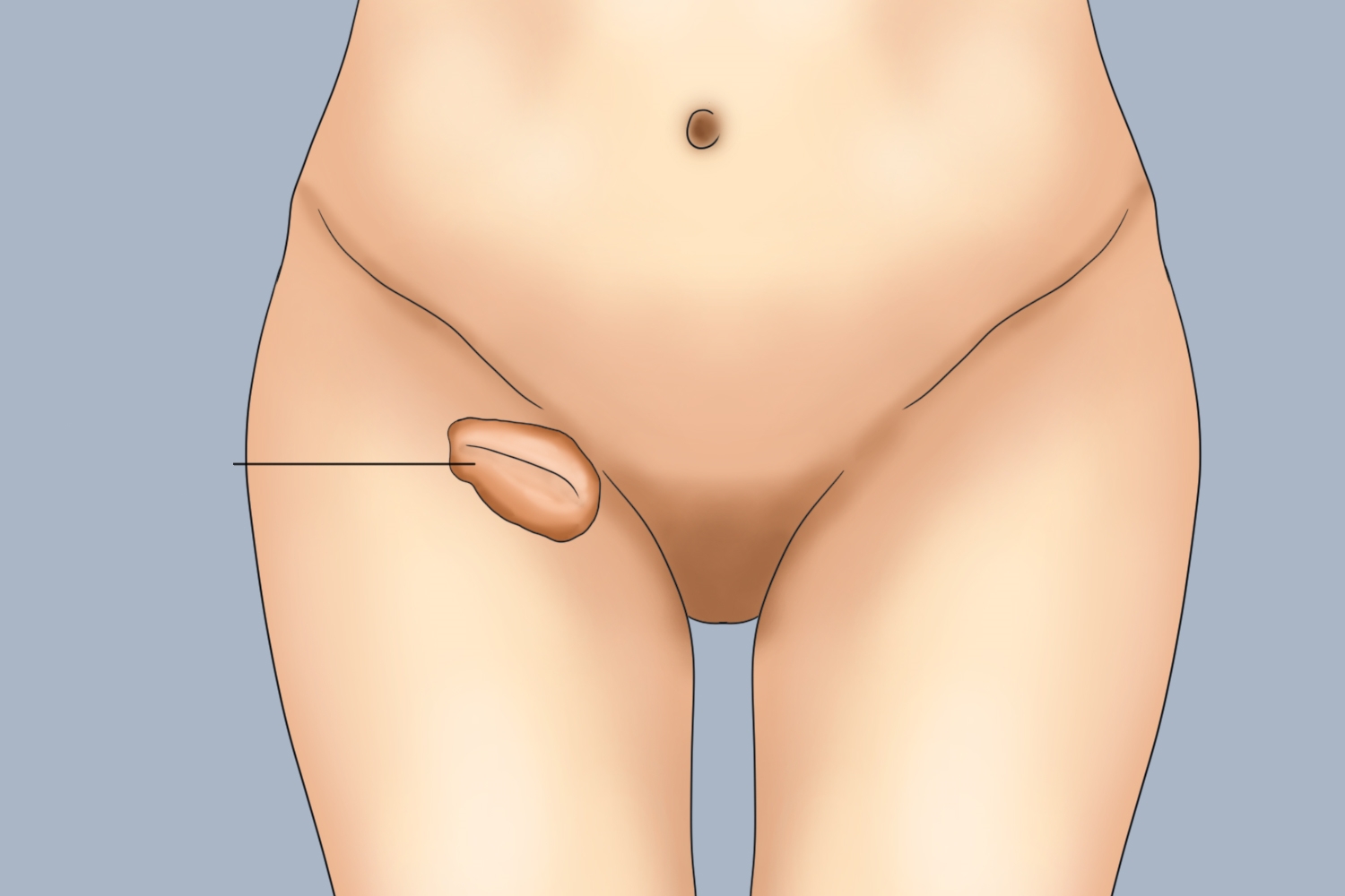 腹股沟直疝大腿肿块图 腹股沟直疝大腿肿块图