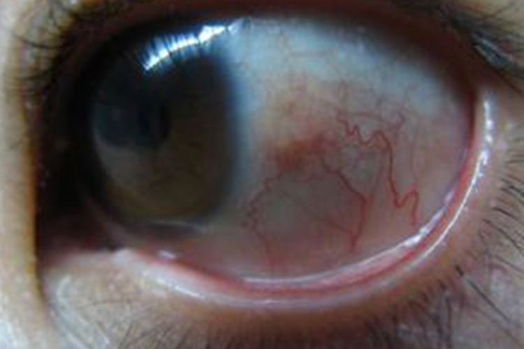 眼睛干燥充血图