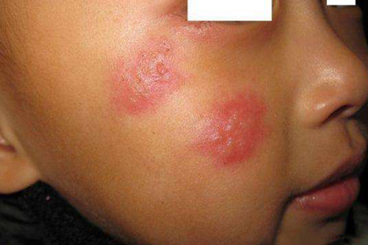 婴儿脸上单纯疱疹图