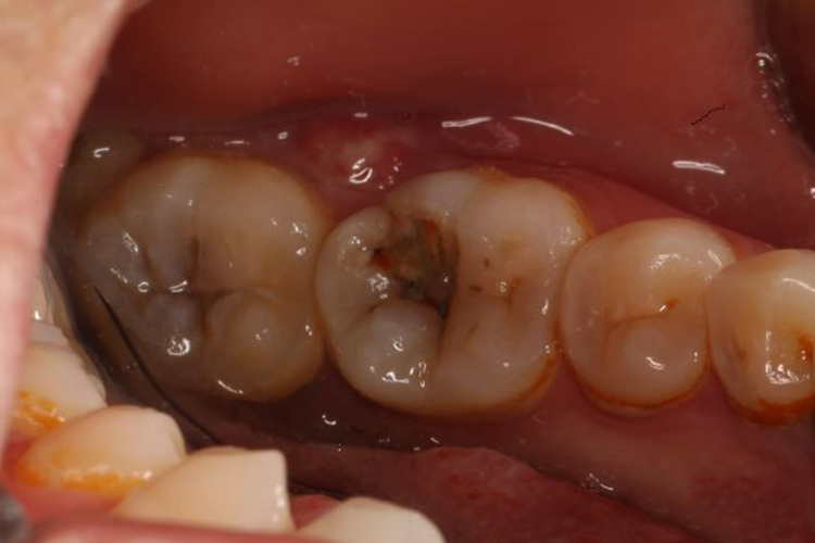 急性牙周脓肿图 急性牙周脓肿图