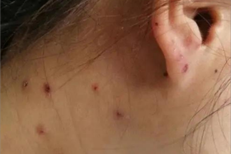 湿疹型多形性日光疹侧颈结痂图