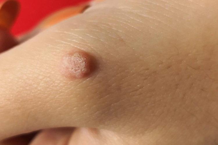 HPV寻常疣图 HPV寻常疣图