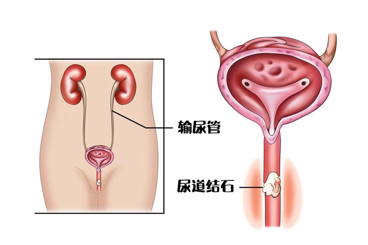 尿道结石图