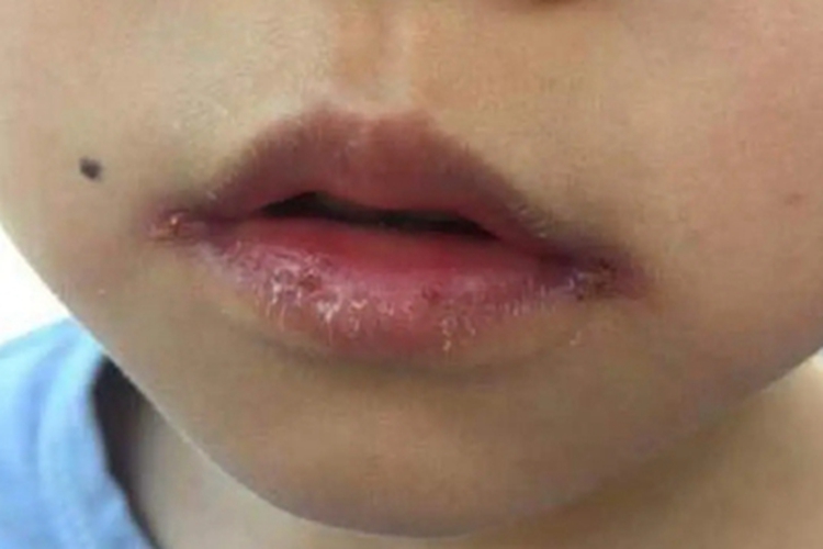 慢性唇炎儿童嘴角裂口脱皮图