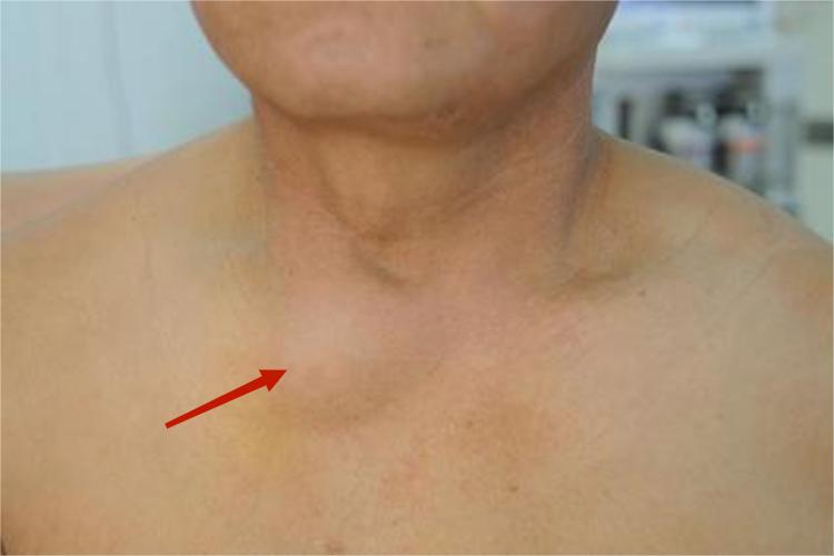 胸锁关节脱位图