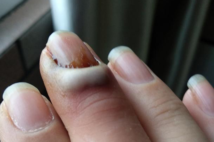 甲沟炎图 甲沟炎图