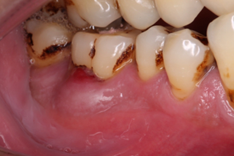 牙槽脓肿局部形成脓肿图 牙槽脓肿局部形成脓肿图