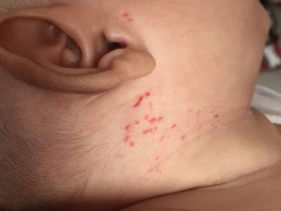 丛状血管瘤侧颈部多个小红疙瘩图