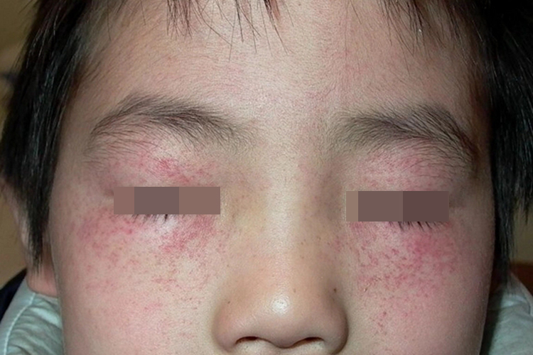 孩子眼睛周围过敏性紫癜图