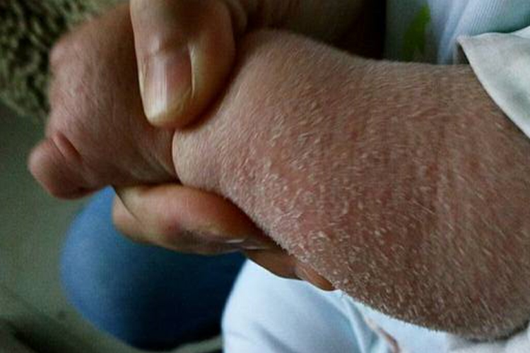 先天性大疱性鱼鳞病样红皮病图 先天性大疱性鱼鳞病样红皮病图