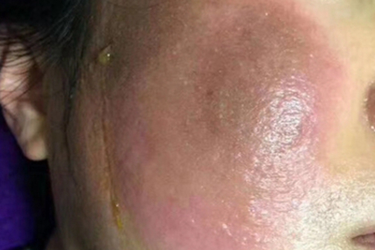 糖皮质激素依赖性皮炎面部丘疹图 糖皮质激素依赖性皮炎面部丘疹图