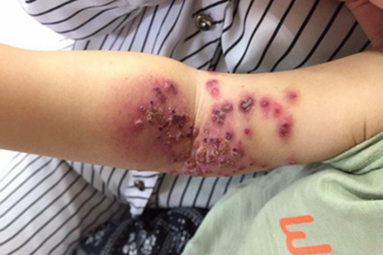 疱疹样湿疹胳膊水疱图